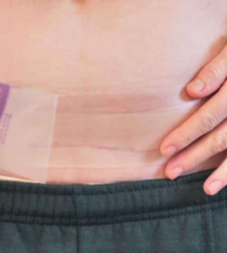 Lansinoh Hydrogel keizersnede patch